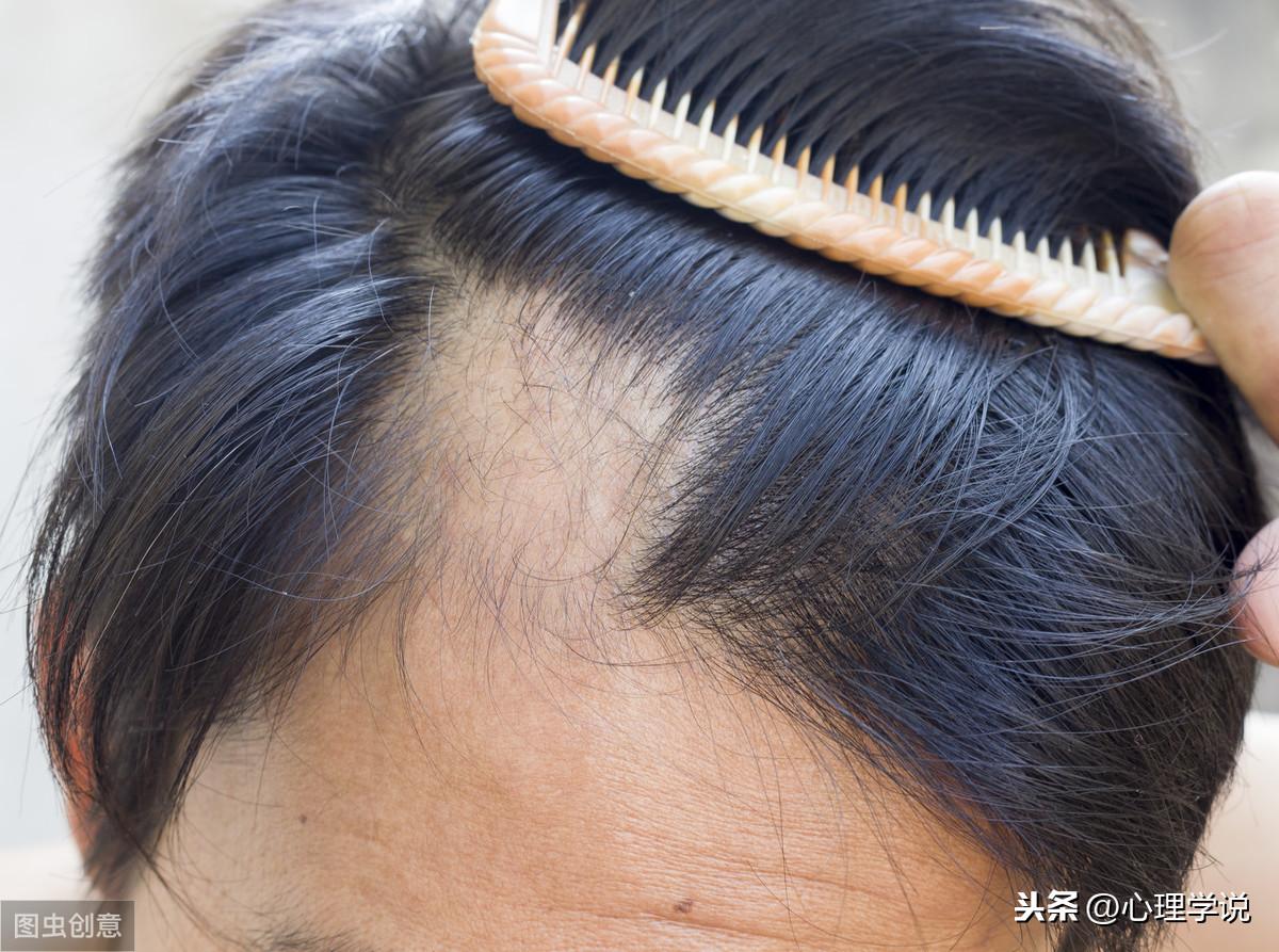 禿頂最新研究,禿頂最新研究，揭示原因、影響與潛在治療策略